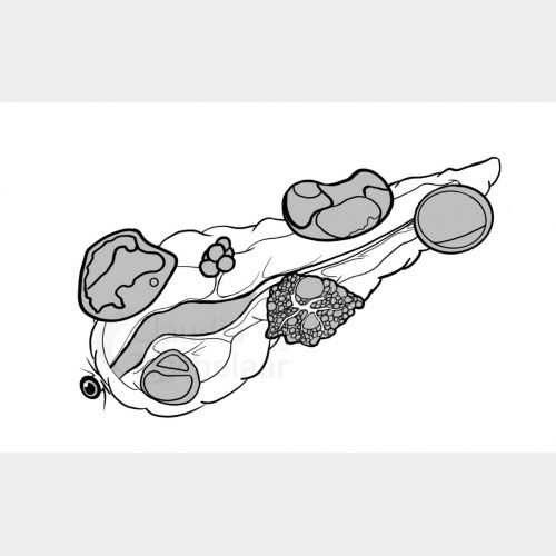 Pancreascysten donker waterm.jpg