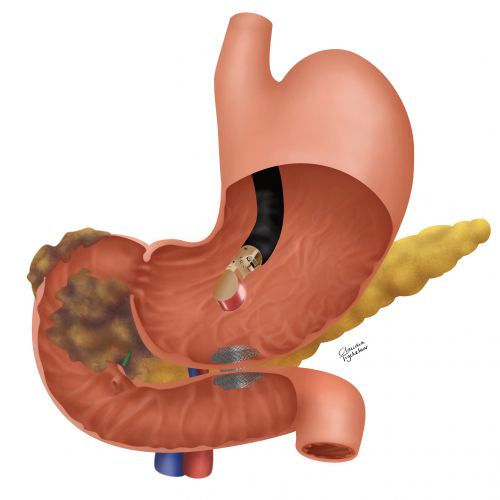 Hot Axios stent merk.jpg