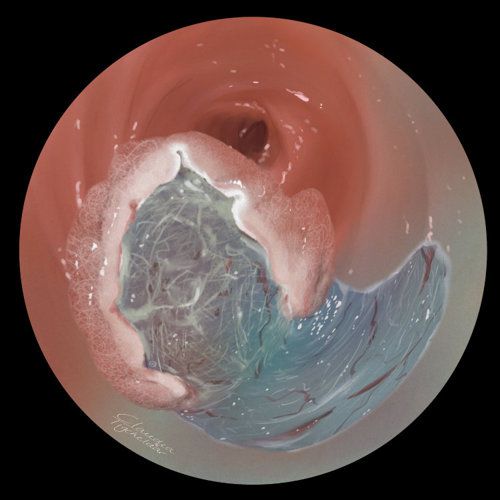 Poliep Colon ESD -RGB merk.jpg